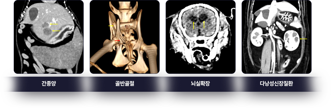 간종양-골반골절-뇌실확장-다낭성신장질환
