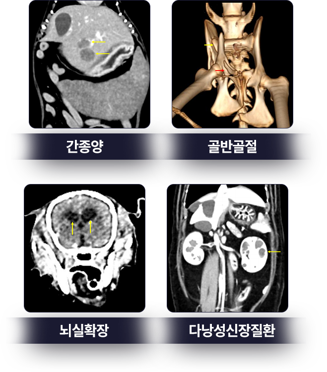 간종양-골반골절-뇌실확장-다낭성신장질환